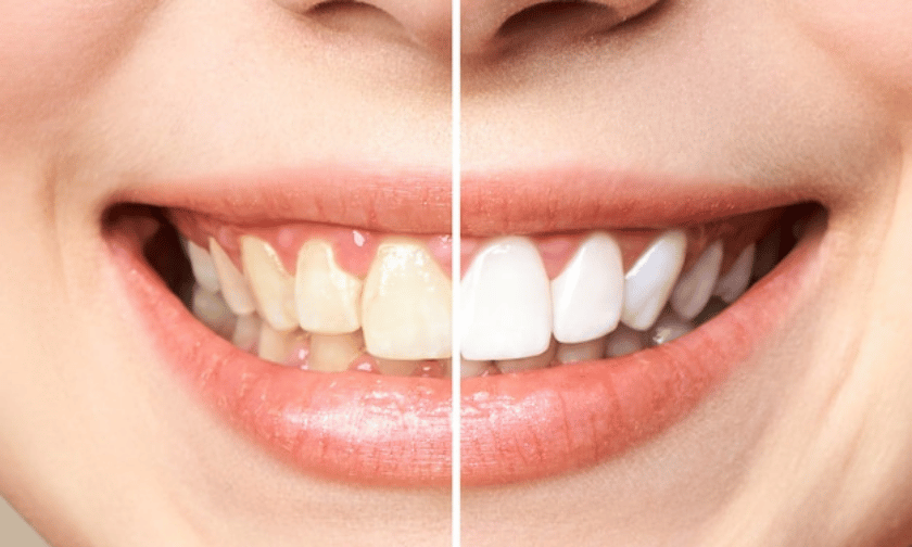 Healthy Professional Teeth Whitening