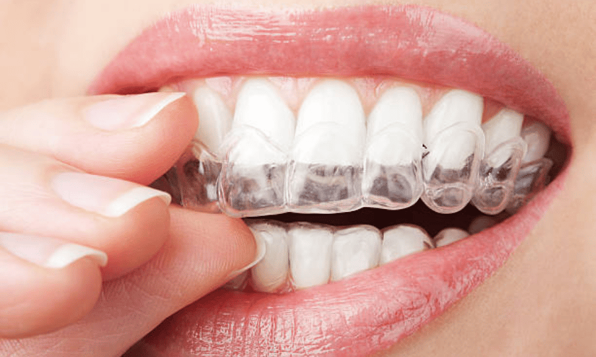 The Best Ways To Clean Your Invisalign Clear Aligners