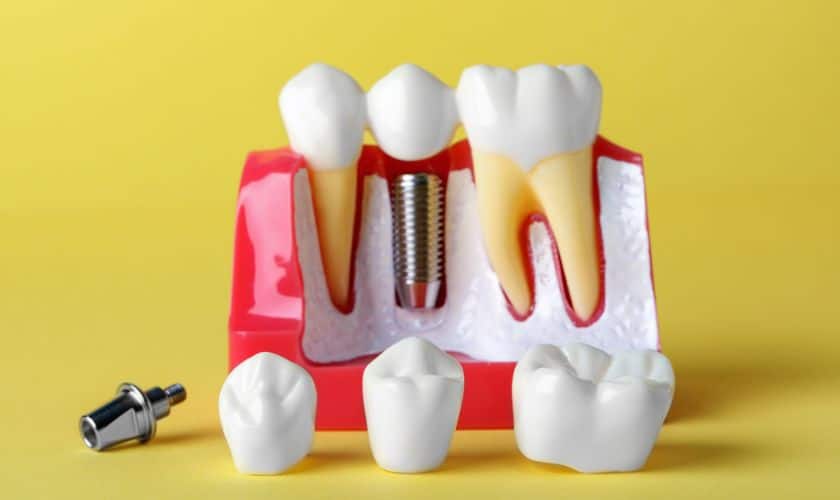 Dental Implants Windsor – Benchmark Dental Windsor Dental Implants Windsor - Benchmark Dental Windsor