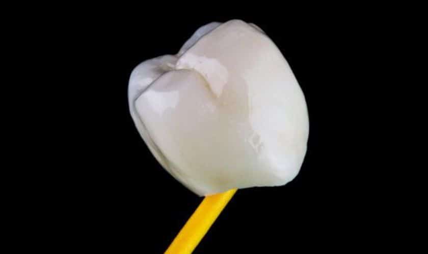 Dental Crowns Windsor Dental Crowns Windsor