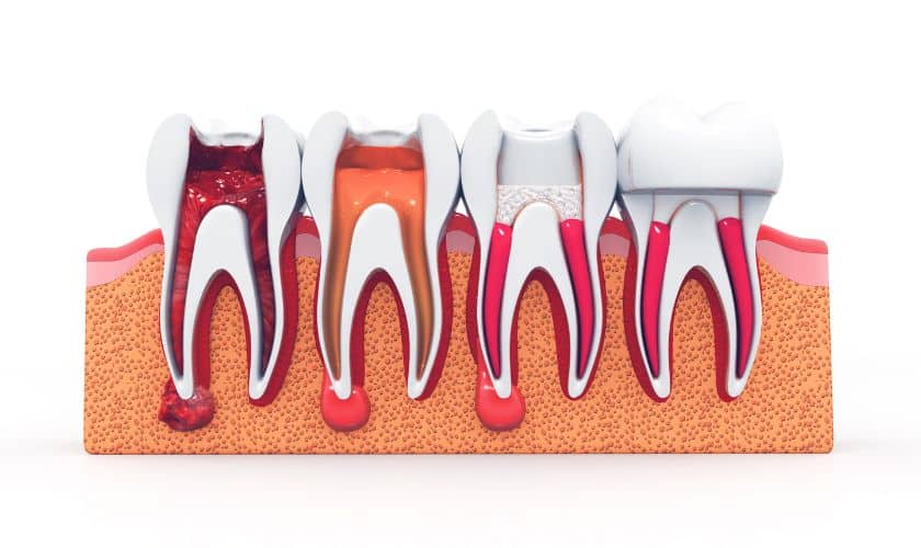 Root Canal Therapy Windsor Caring for Your Teeth After Root Canal