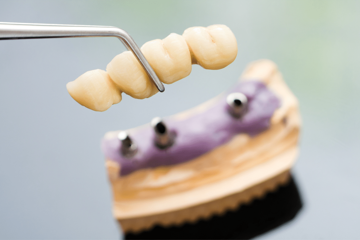 Common Challenges with Dentures and Bridges Solutions for a Brighter Smile Common Challenges with Dentures and Bridges Solutions for a Brighter Smile