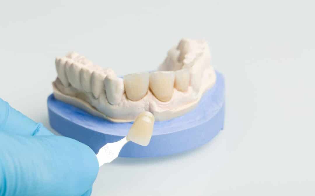 How Veneers Solve the Most Common Dental Imperfections
