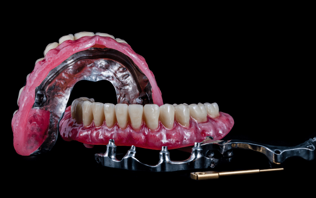 All-On-4 Implants: The Revolutionary Solution for Missing Teeth