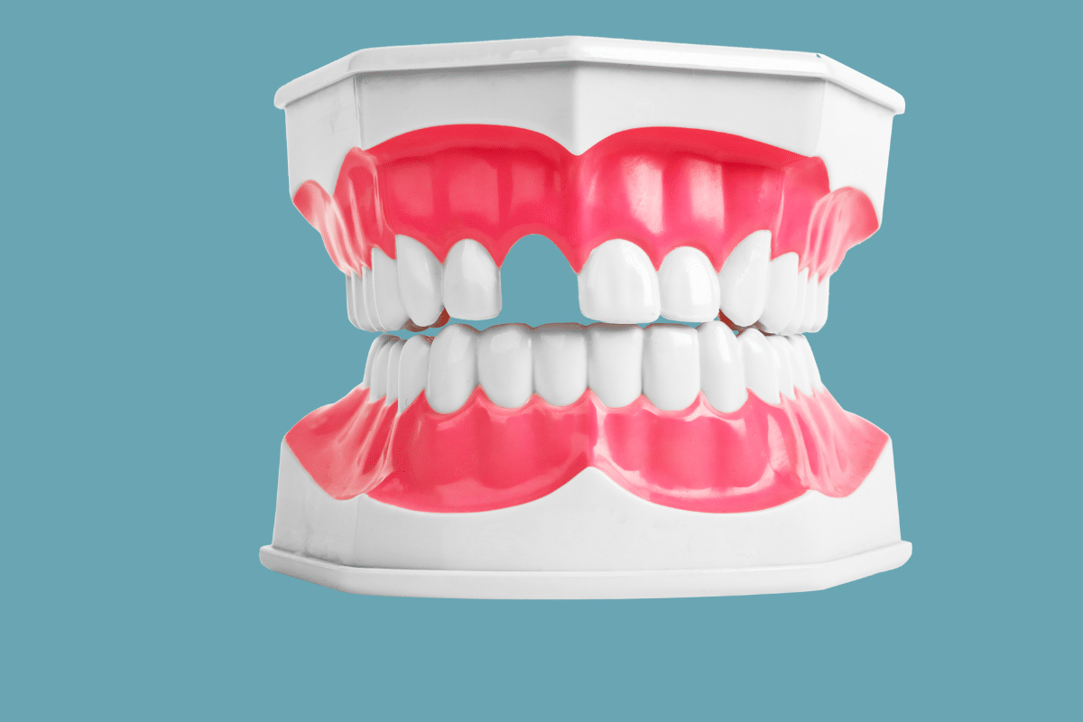 How Bone Grafting Can Help Prevent Tooth Loss? How Bone Grafting Can Help Prevent Tooth Loss?