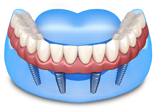 Dental implant model showing prosthetic teeth on implant posts in gum tissue.