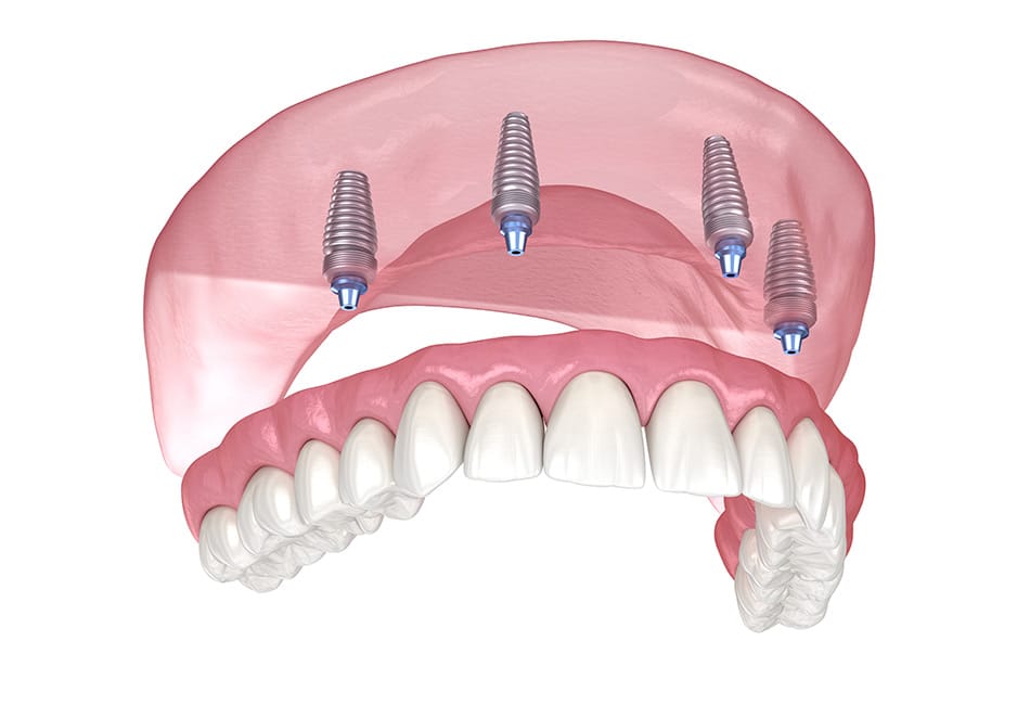 Dental implant prosthesis showing four titanium implants supporting upper arch denture model.