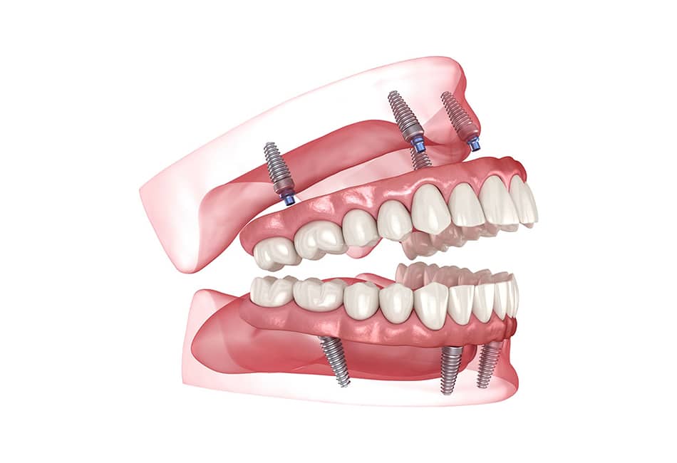 Dental implant model showing prosthetic teeth and titanium posts in jaw structure.