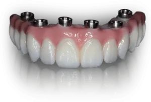 Dental implant prosthesis showing ceramic crowns on titanium implant posts with gum simulation.