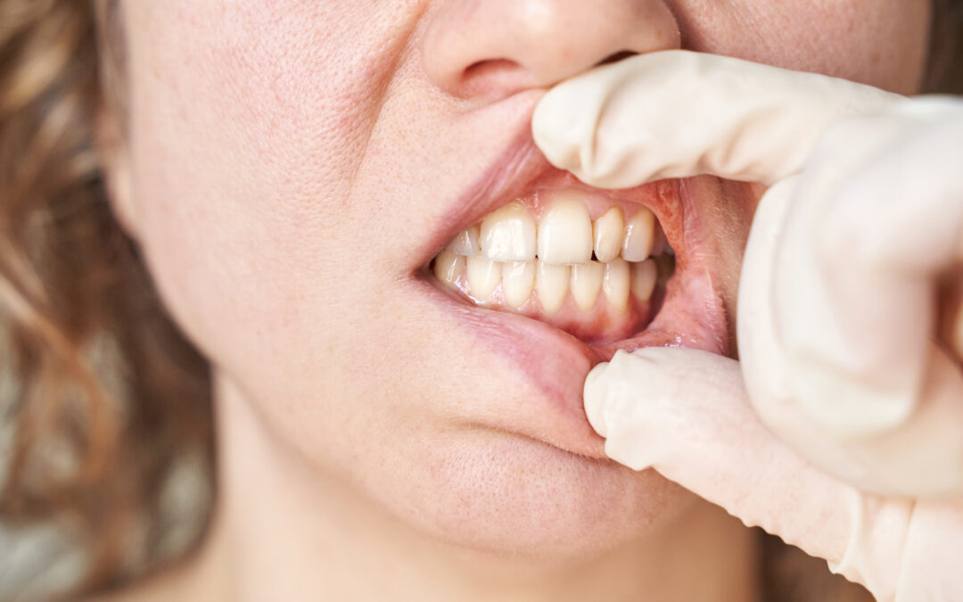 Causes and Solutions for Gray-Tinted Teeth