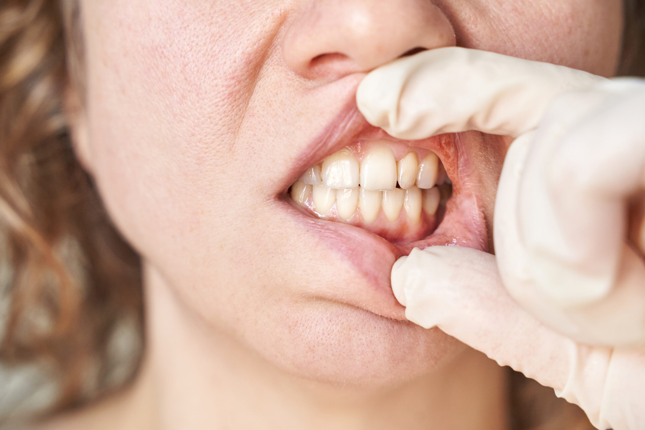Female Caucasian adult dental examination with gloved hands close up teeth Close-up of a dental exam showing a patient’s teeth and gums, highlighting discoloration and areas being evaluated for gray-tinted teeth