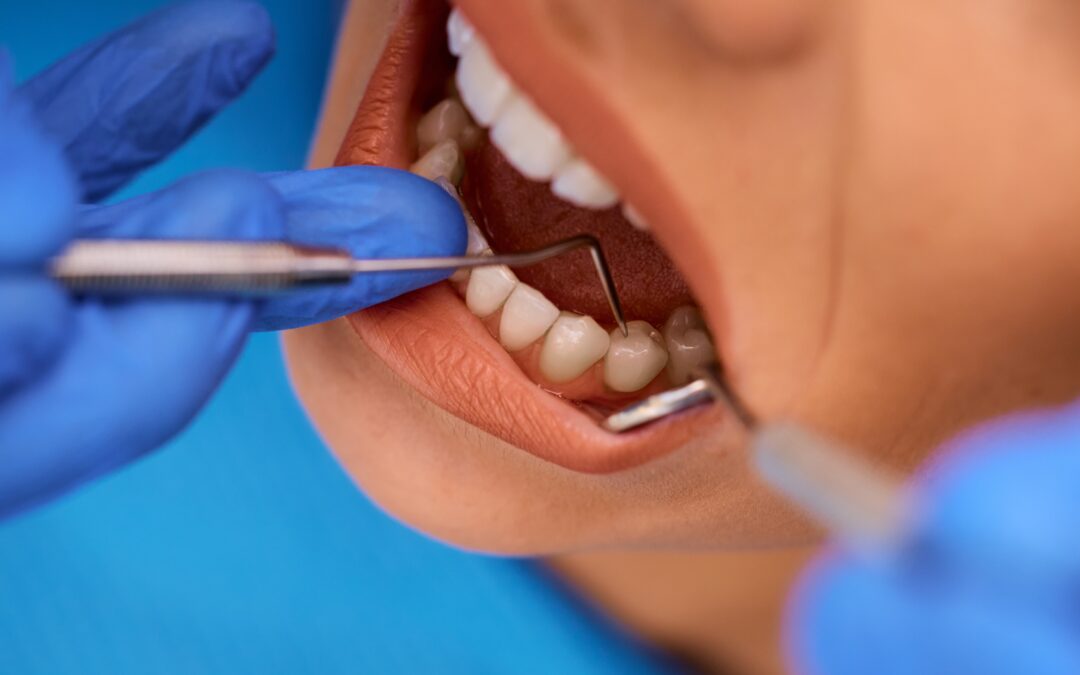 How Plaque and Tartar Build-Up Can Impact Overall Oral Health